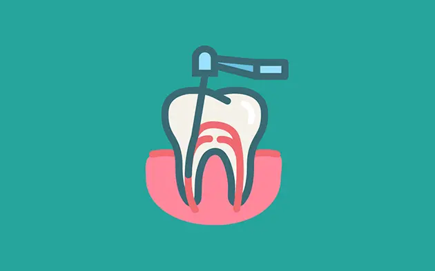 endodoncia en consultorio dental avdental en venustiano carranza cdmx